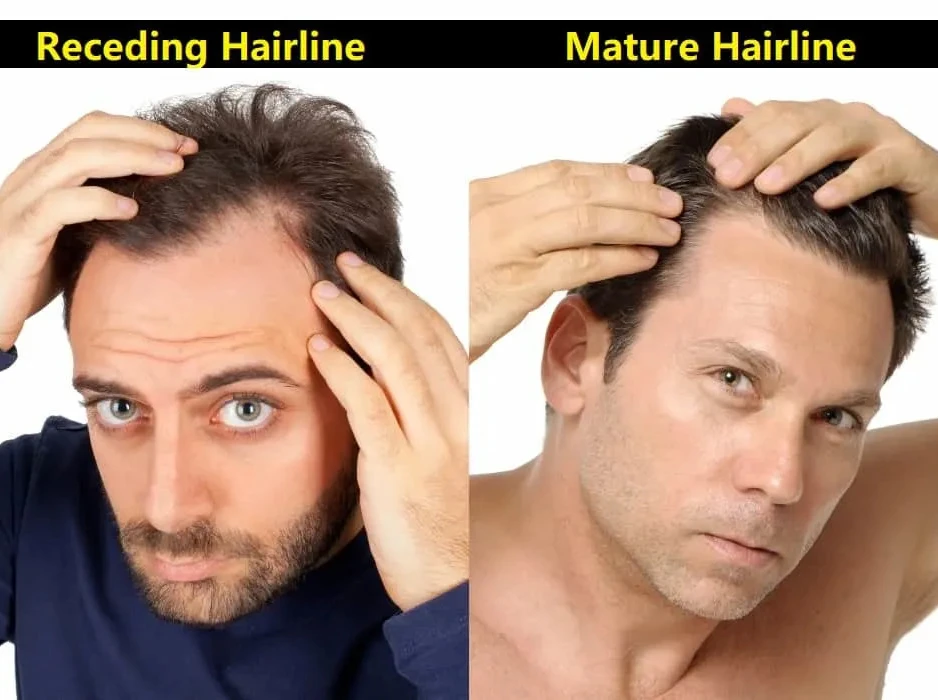 Receding Hairline or Mature Hairline Learn the Key Differences