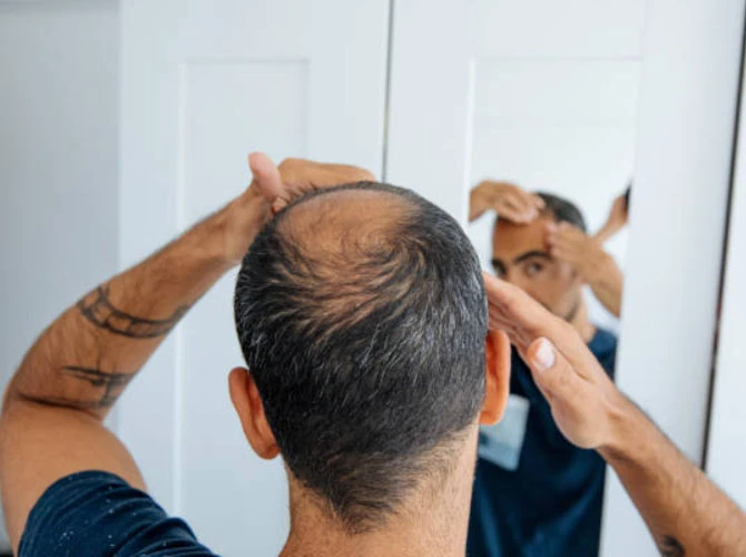 Receding Hairline: Causes, Prevention, and Solutions